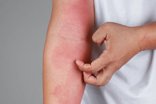 Living with Eczema: What It Is, Understanding Your Skin, and How to Manage and Treat - Rufi Eco Store